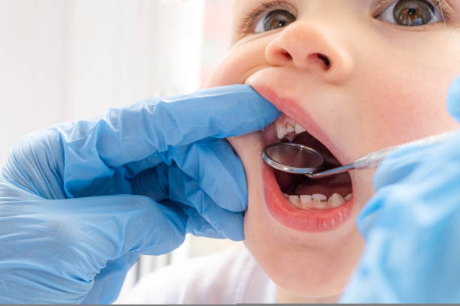 El impacto del consumo excesivo de azúcar en la salud dental infantil